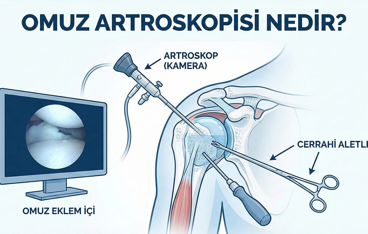 omuz-artroskopisi-